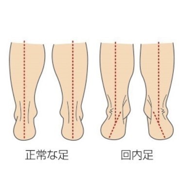 後脛骨筋腱障害・回内足