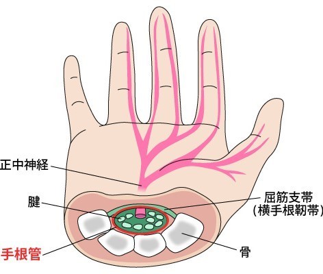 手根管症候群