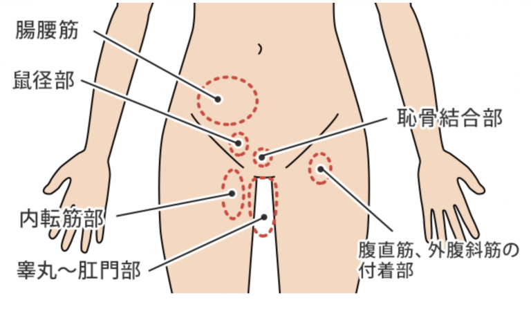 鼡径部痛症候群・グロインペイン症候群・痛みの部位