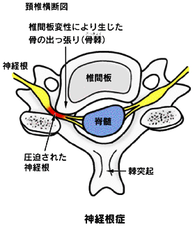 頚椎症｜神経根症