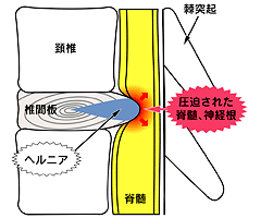 頚椎椎間板ヘルニアの病態