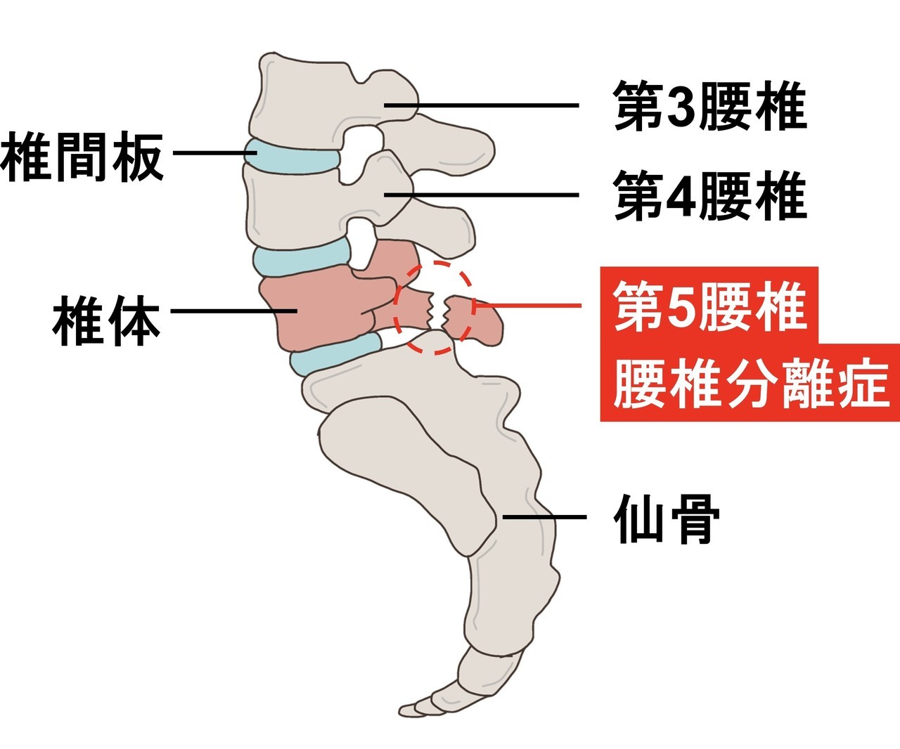 腰椎分離症