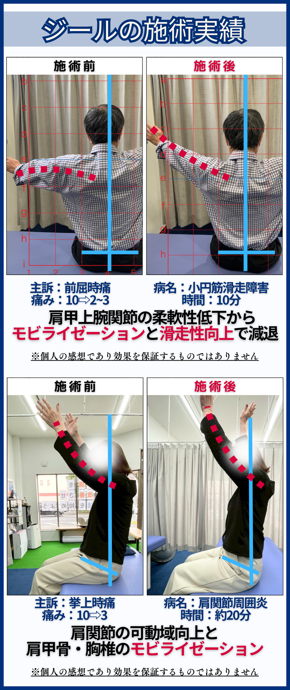 四十肩・五十肩 - 倉敷市ジール鍼灸整骨院 ｜整体院