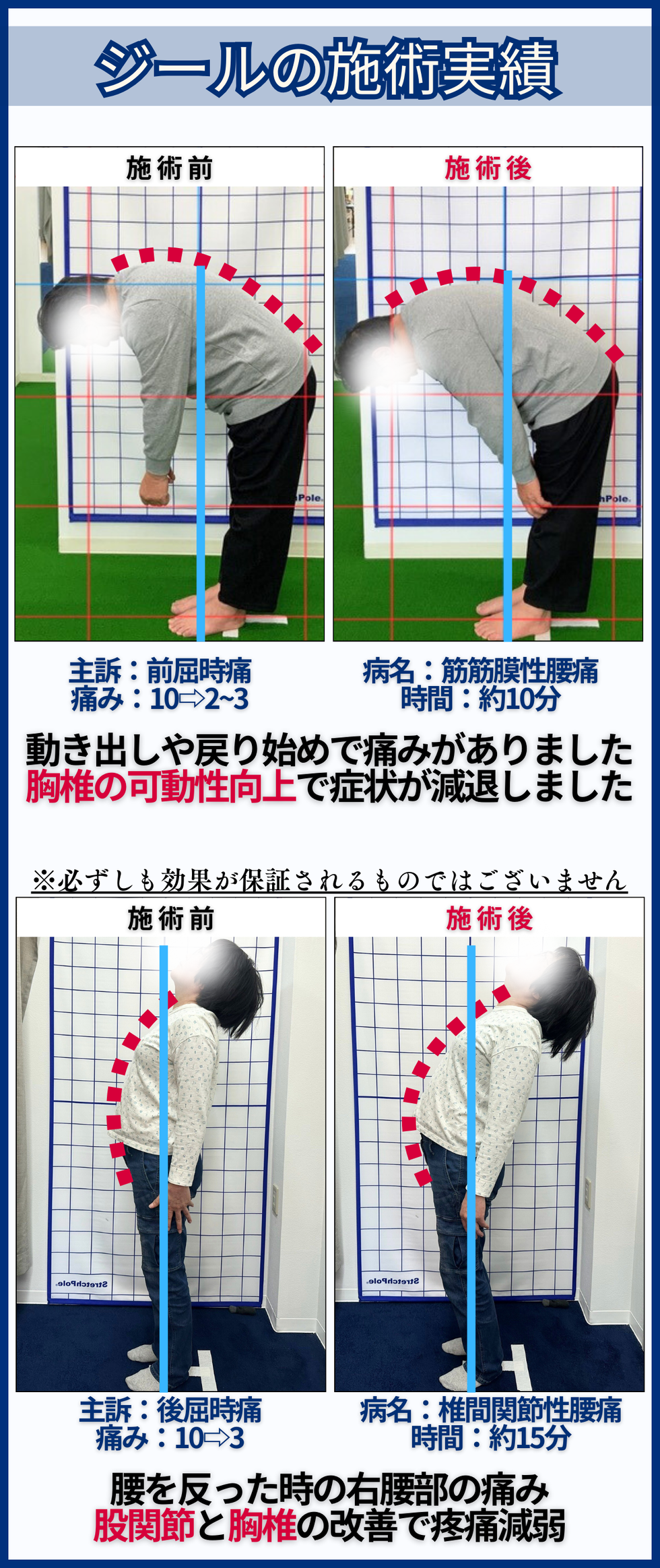ぎっくり腰｜筋筋膜性腰痛 - 倉敷市ジール鍼灸整骨院 ｜整体院