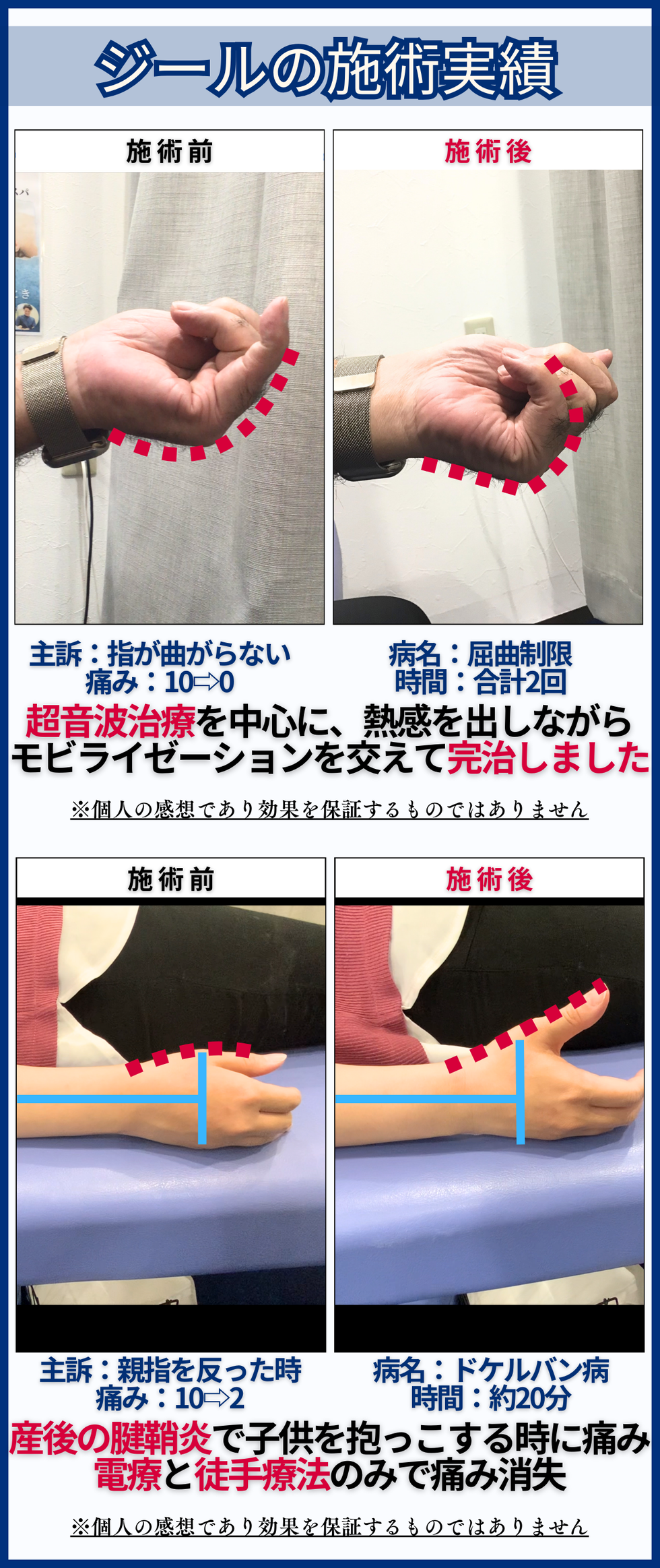 腱鞘炎(手の痛み) - 倉敷市ジール鍼灸整骨院 ｜整体院