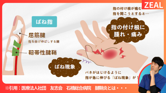 ばね指（弾発指） - 倉敷市ジール鍼灸整骨院 ｜整体院