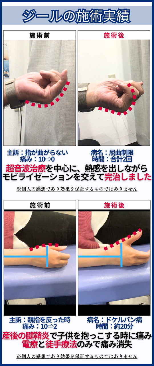 腱鞘炎(手の痛み) - 倉敷市ジール鍼灸整骨院 ｜整体院